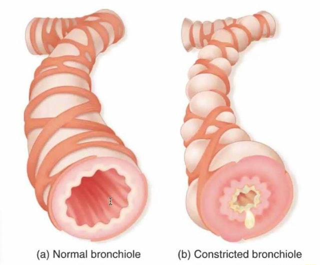 (a) Normal bronchiole (b) Constricted bronchiole - iFunny