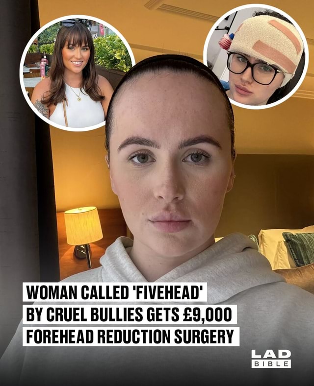 Beth Halsey Went Under The Knife For A Forehead Reduction After Being Called Fivehead By Cruel