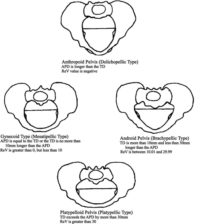 Anthropoid Pelvis (dolichopellic Type) Apd Is Longer Than The Td Rev 