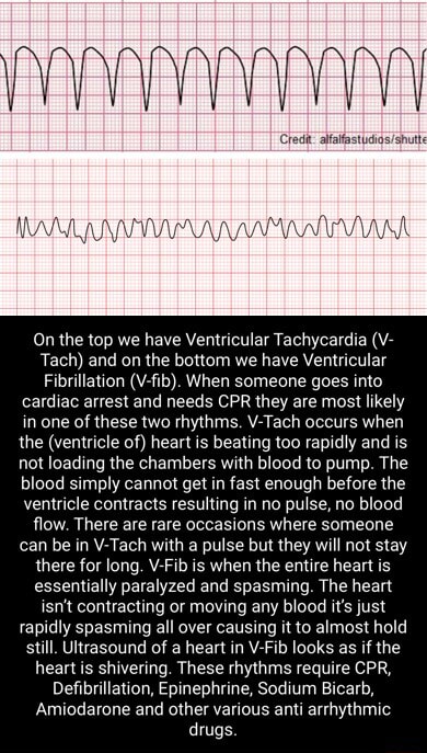 On The Top We Have Ventricular Tachycardia V Tach And On The Bottom We Have Ventricular