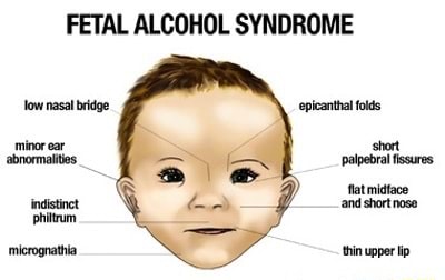 FETAL ALCOHOL SYNDROME low nasal bridge picanthal folds minor ear short ...