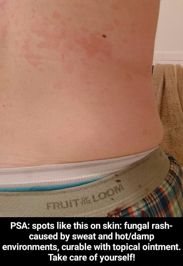 PSA spots like this on skin fungal rash caused by sweat and hot/damp