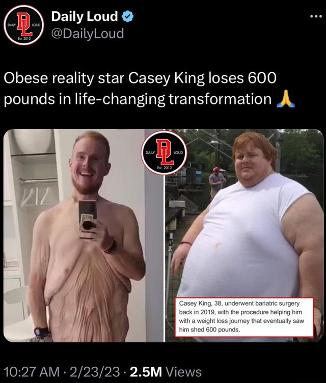 C) Daily Loud Obese reality star Casey King loses 600 pounds in life ...