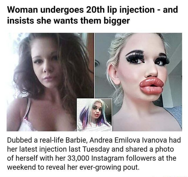 Woman Undergoes 20th Lip Injection - And Insists She Wants Them Bigger 