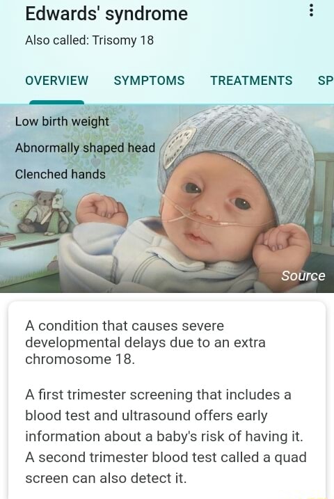 Edwards' Syndrome Also Called: Trisomy 18 OVERVIEW SYMPTOMS TREATMENTS ...