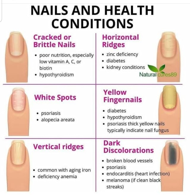 Koilonychia or Spoon Shaped Nails Causes and Spoon Nails Treatment - Remedy  Land