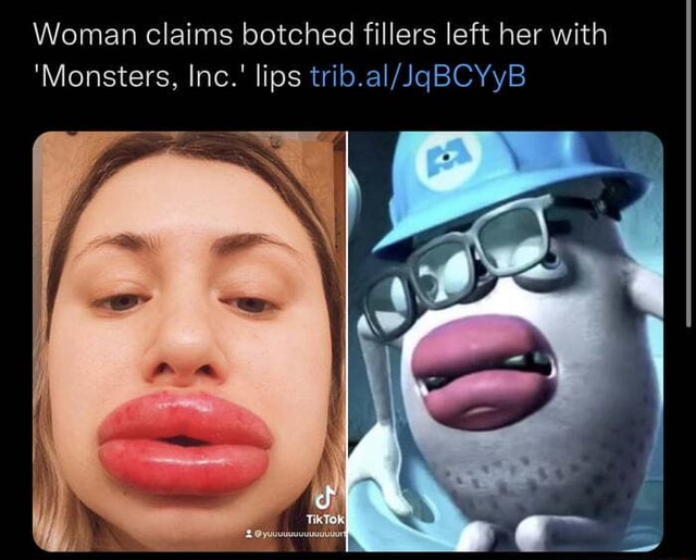 Woman Claims Botched Fillers Left Her With Monsters Inc Lips