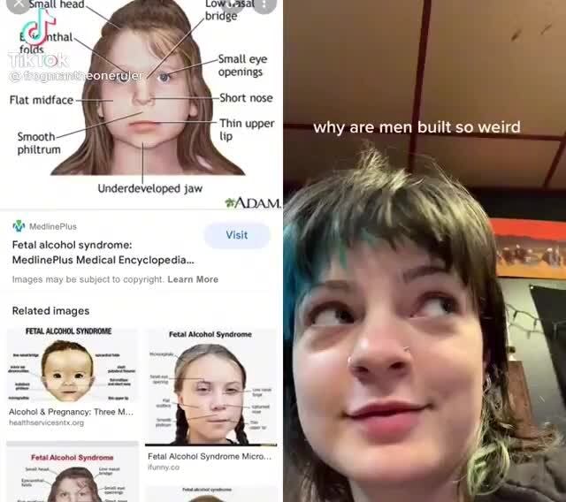 Phittrum Small eye 'openings. Short nose Underdeveloped jaw ADAM. Fetal