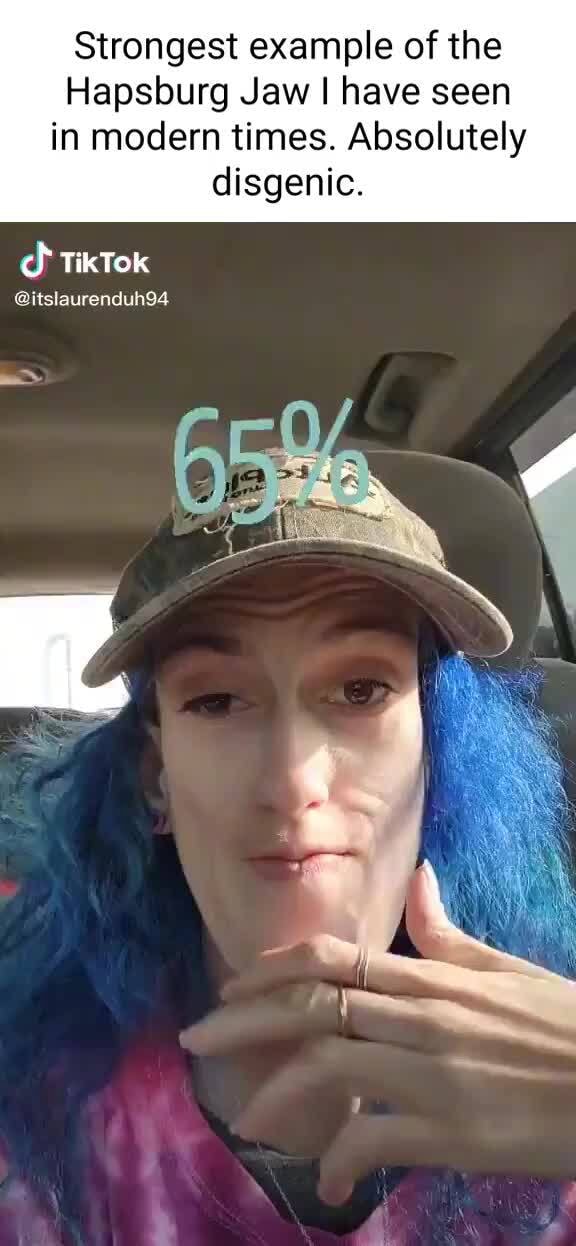 Strongest example of the Hapsburg Jaw I have seen in modern times