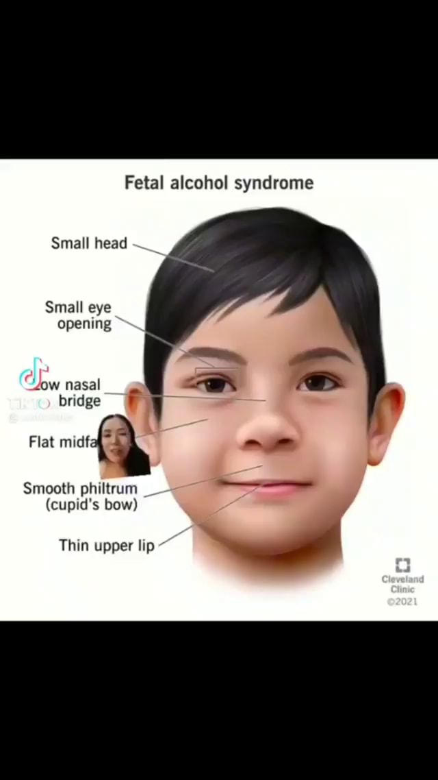 Fetal alcohol syndrome Small head Small eye opening UW nasal bridge ...